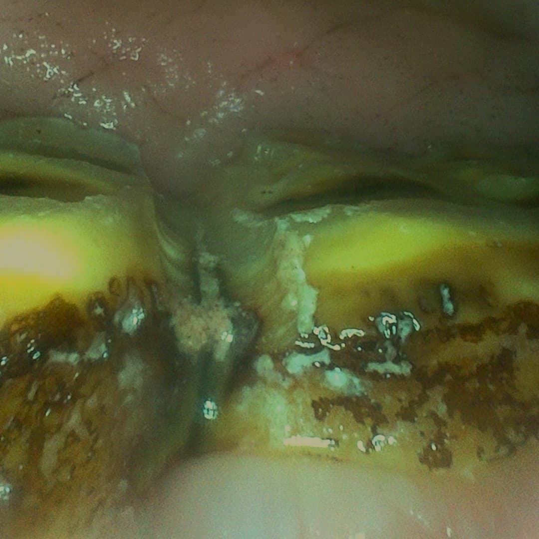Endoscopisch beeld van een diastema met occlusale drukvermindering door diastema relief cut